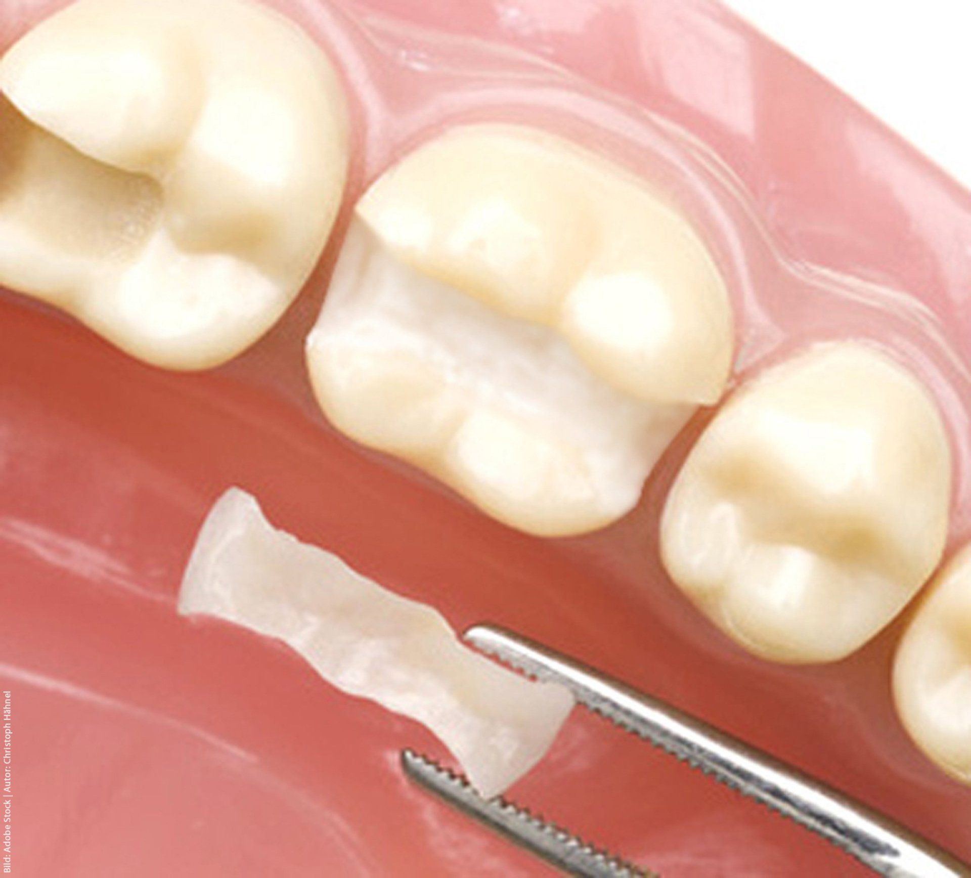 Eine Nahaufnahme eines Zahns mit einem Stück Zahnpasta darauf