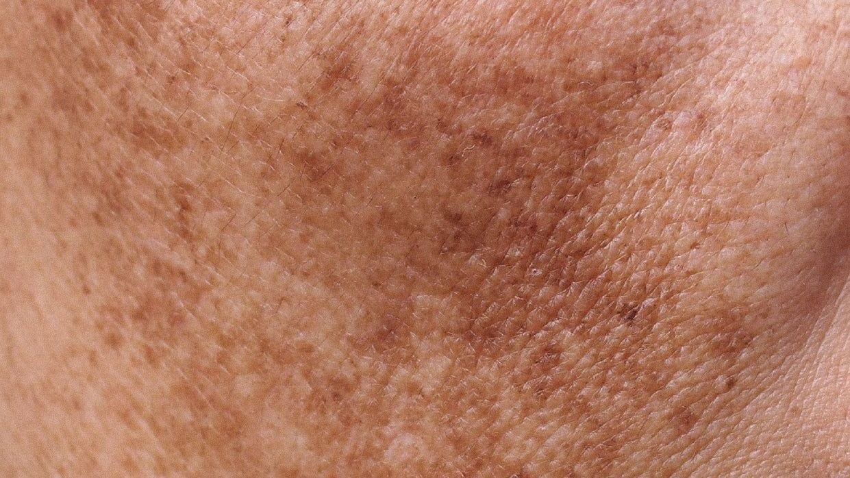 Treats Melasma