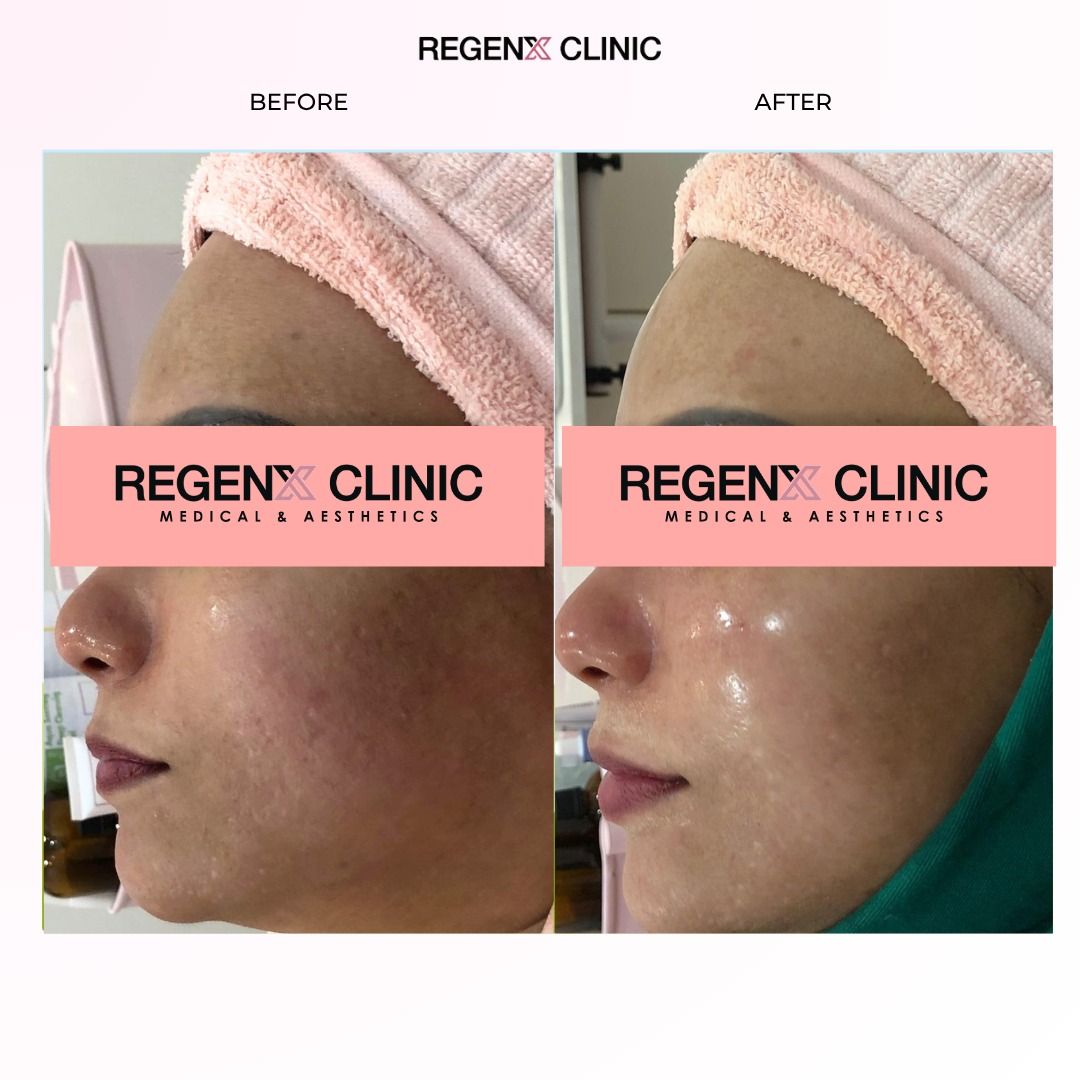 skin booster before and after