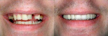 Syosset Dentist | Syosset dental Smile Gallery |