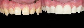Syosset Dentist | Syosset dental Smile Gallery |