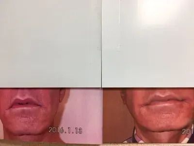 Two photos of a person's lower face, showing lips and chin, likely demonstrating a medical before-and-after.