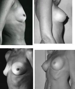 Four black and white side profile views of a person's breasts, showing different sizes and shapes.