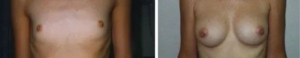 Before and after photos: Chest without and with breasts.