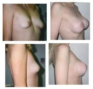 Before and after breasts: small, then enlarged; pale skin.