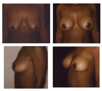 Four views of a person's breasts before and after augmentation surgery, showcasing the change in size and shape.