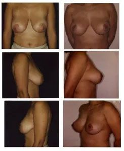 Before and after breast augmentation comparison. Six photos: frontal and side views of breasts.