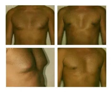 Before and after photos of a man's chest showing gynecomastia surgery results. Skin is tan.
