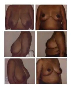 Six views of a person's breasts: front, side, and angled perspectives, showing size and shape variations.