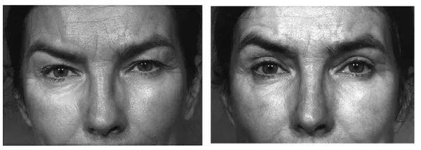 Two grayscale close-up facial photos side by side.