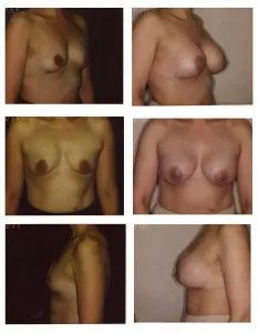 Before and after photos of a person's breasts, showing changes in size and shape.