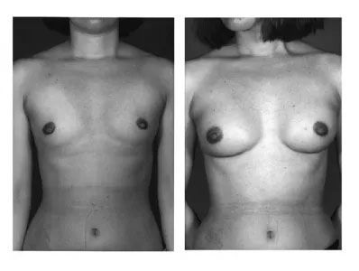 Two grayscale torso views: pre- and post-breast augmentation. Left: small breasts. Right: fuller breasts.