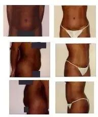 Before and after body transformation photos, showcasing stomach and side views.