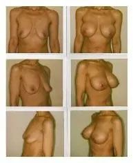 Series of images showing before and after breast augmentation.