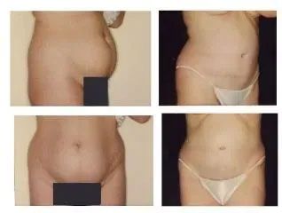 Four-panel comparison showing a person's abdominal area before and after a procedure, with visible changes in shape.