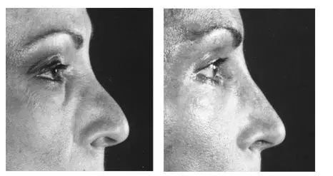 Before and after profile views of a person's nose, showing rhinoplasty.