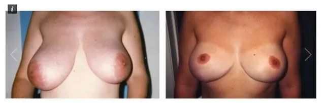 Before and after photos of breast reduction surgery.