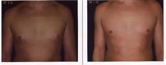 Two photos of a person's chest. One before, one after a medical procedure, with skin tone change.