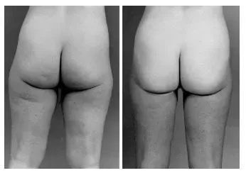 Two black and white photos of a person's rear, showing buttocks before and after a procedure.