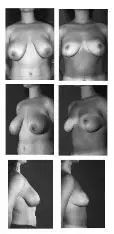 Photographic comparison of before and after breast surgery, from multiple angles.