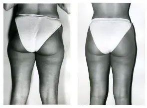 Before and after photos of woman's legs, showing reduction of cellulite on thighs.