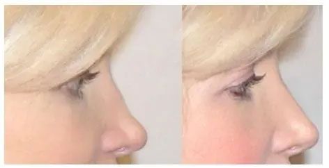 Before-and-after profile of a woman's nose. Left: bump on bridge. Right: smoother bridge.
