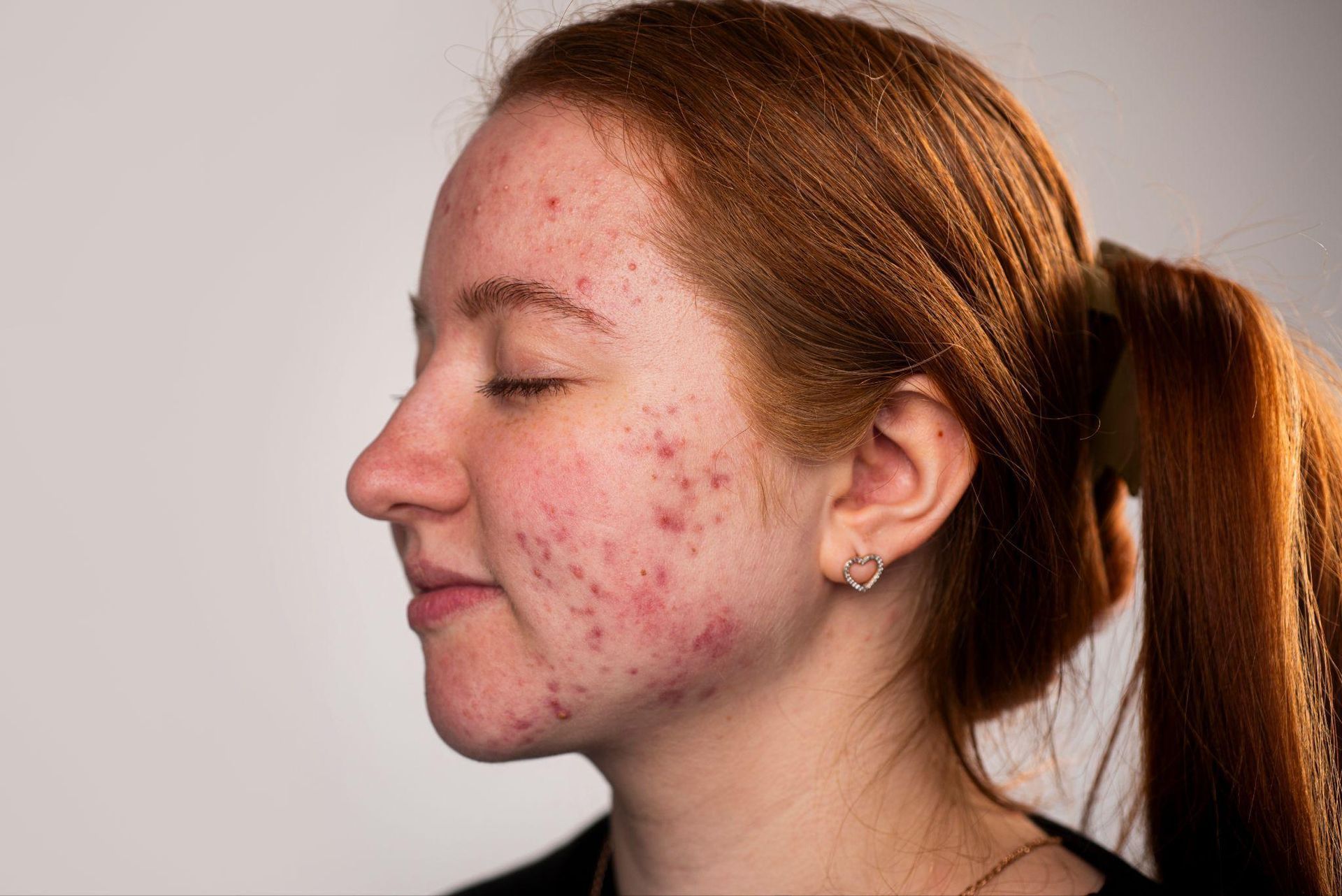 Acne Treatment in Grants Pass, OR: 10 Tips to Flawless Skin