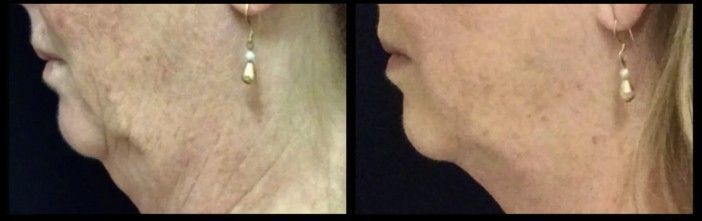 How Long Ultherapy Results Last