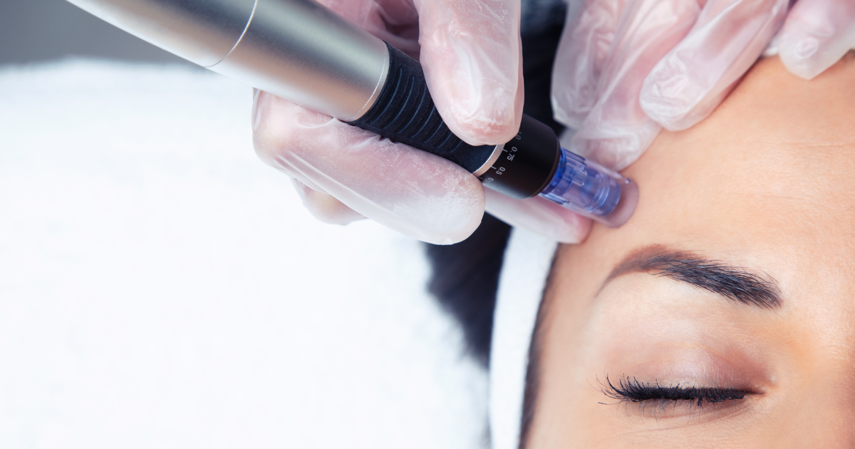 3 Myths About Microneedling, Debunked