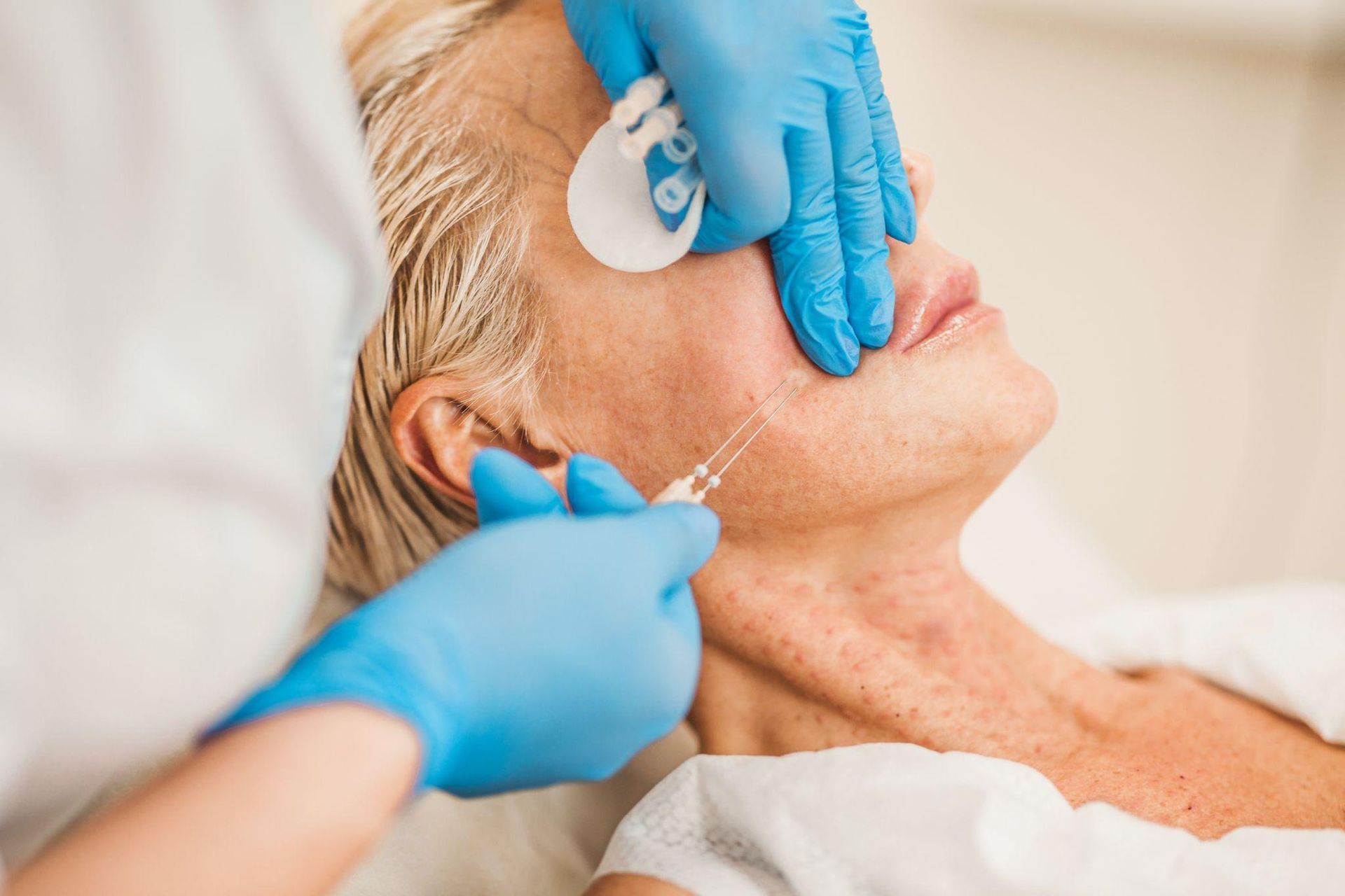 PDO Thread Lift in Grants Pass, OR – Youthful Skin Restored