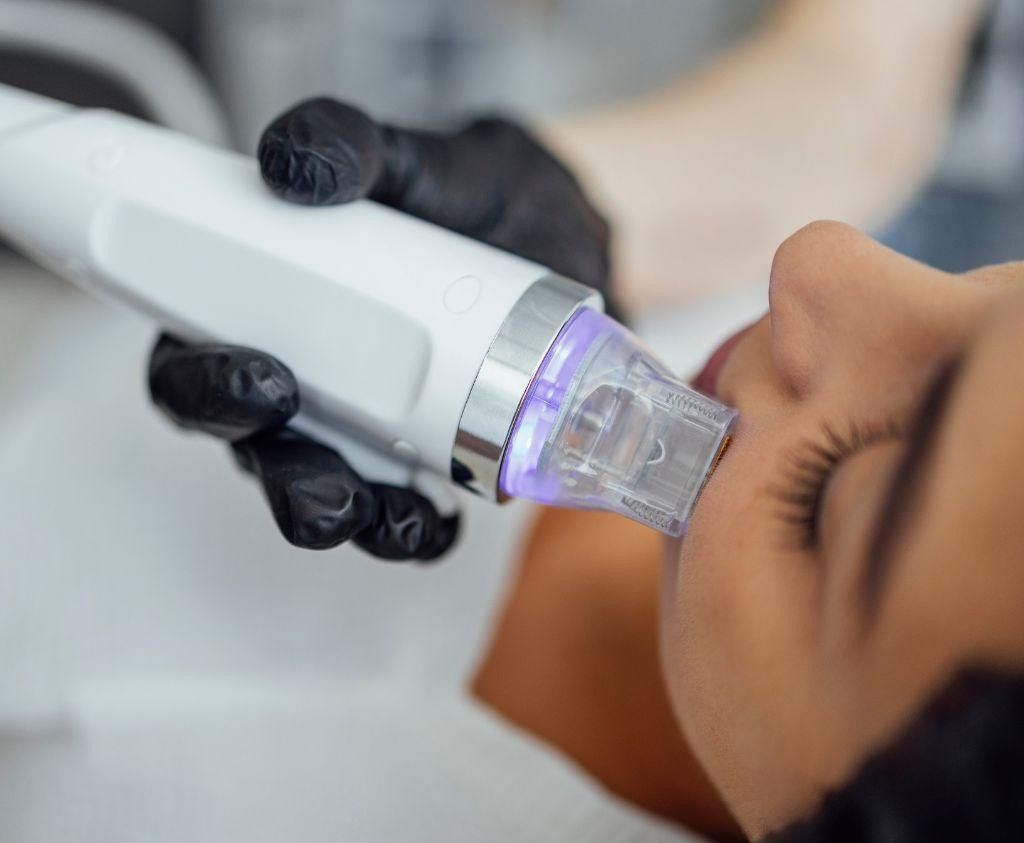RF Microneedling Benefits Results