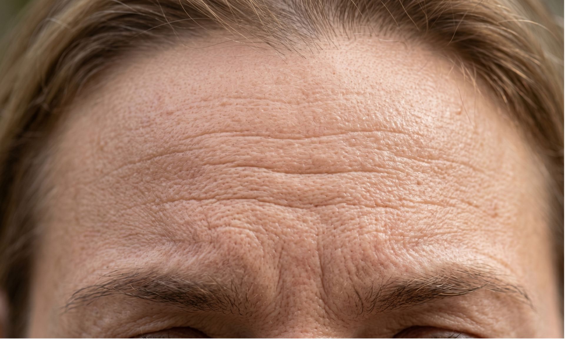 What Are Forehead Lines?