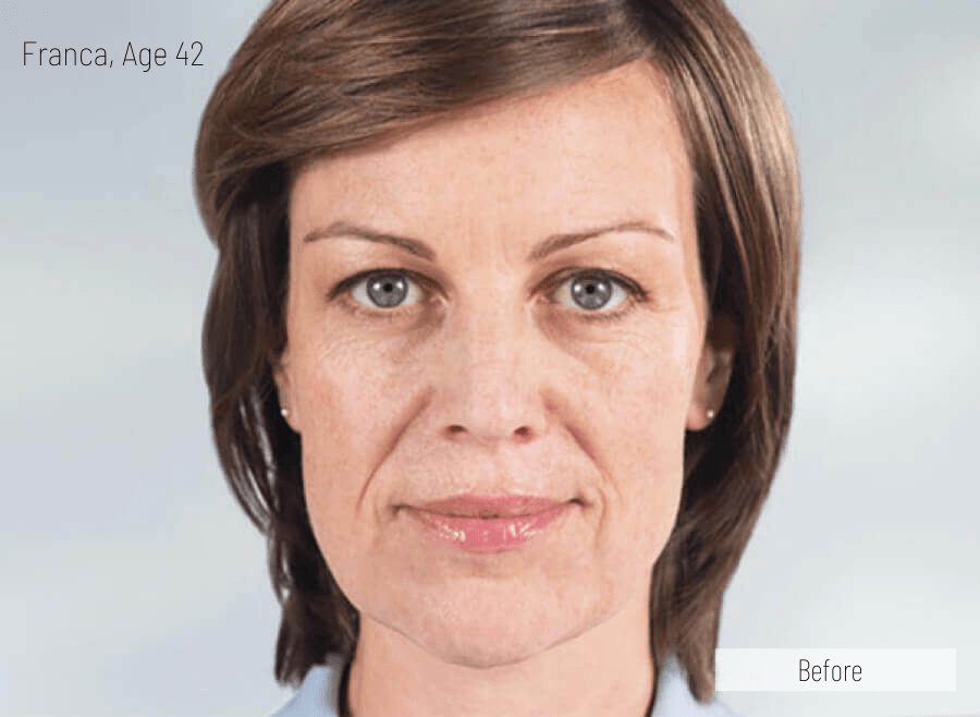 loss of collagen and elastin