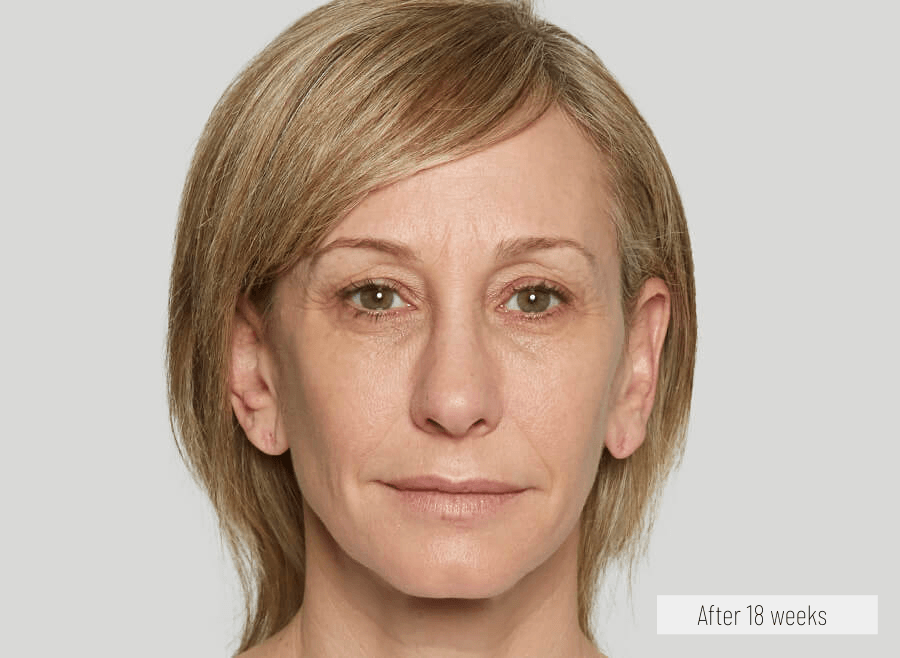 loss of collagen and elastin