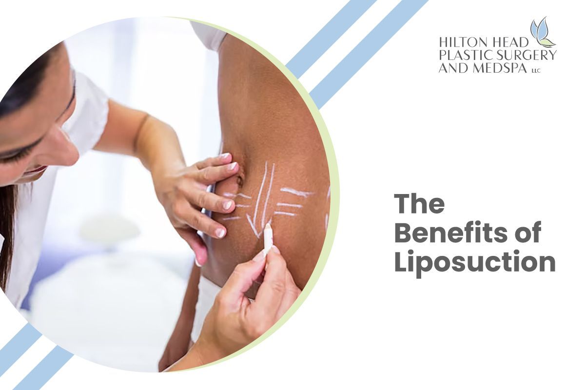 The Benefits of Liposuction