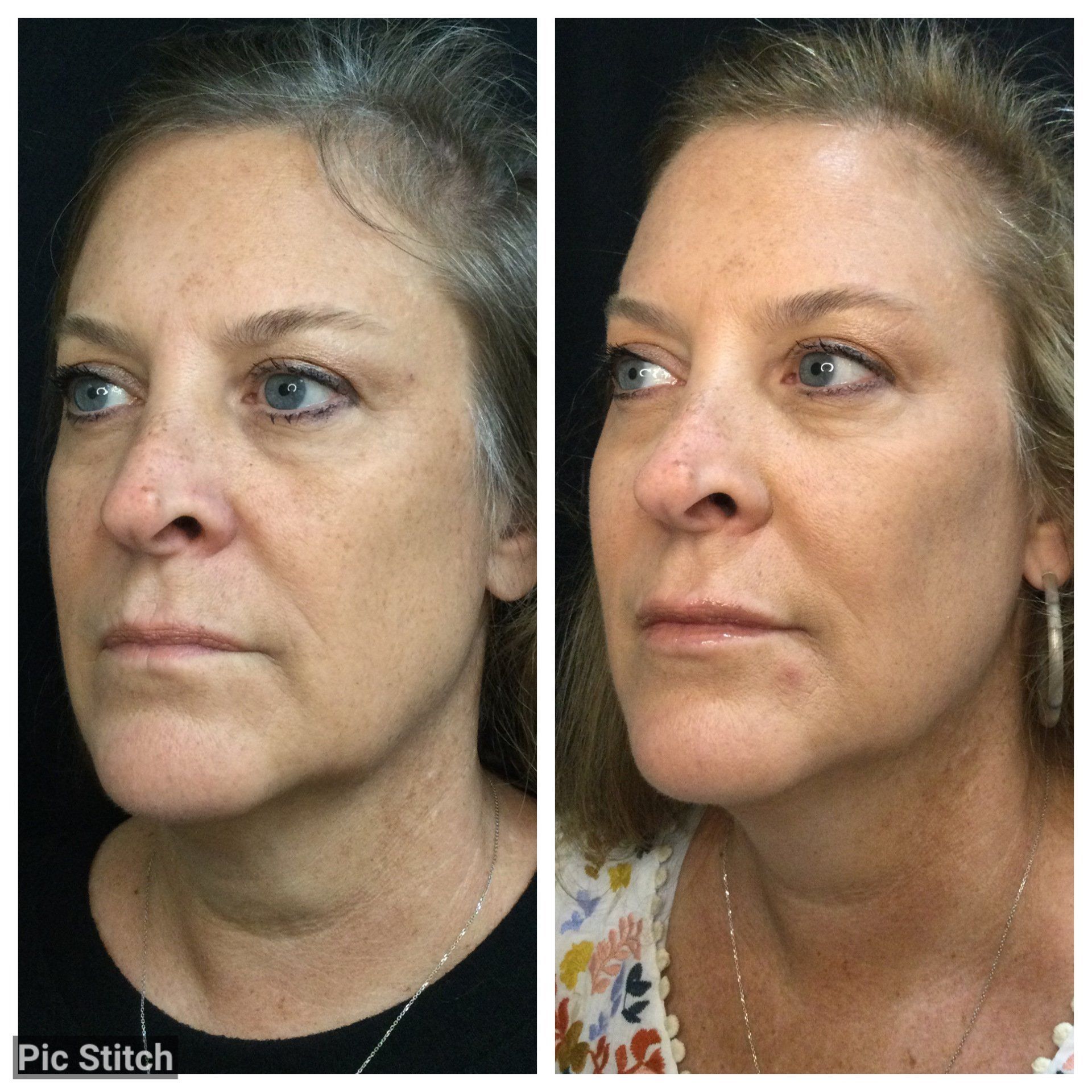 Before & After Photo | Hilton Head Plastic Surgery & MedSpa