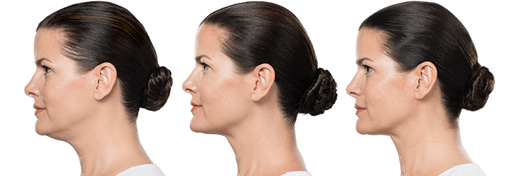 Chin Injections to Reduce Fat Beneath the Jawline