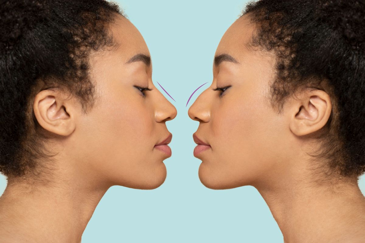 Surgical and Non-Surgical Rhinoplasty: What’s the Difference?