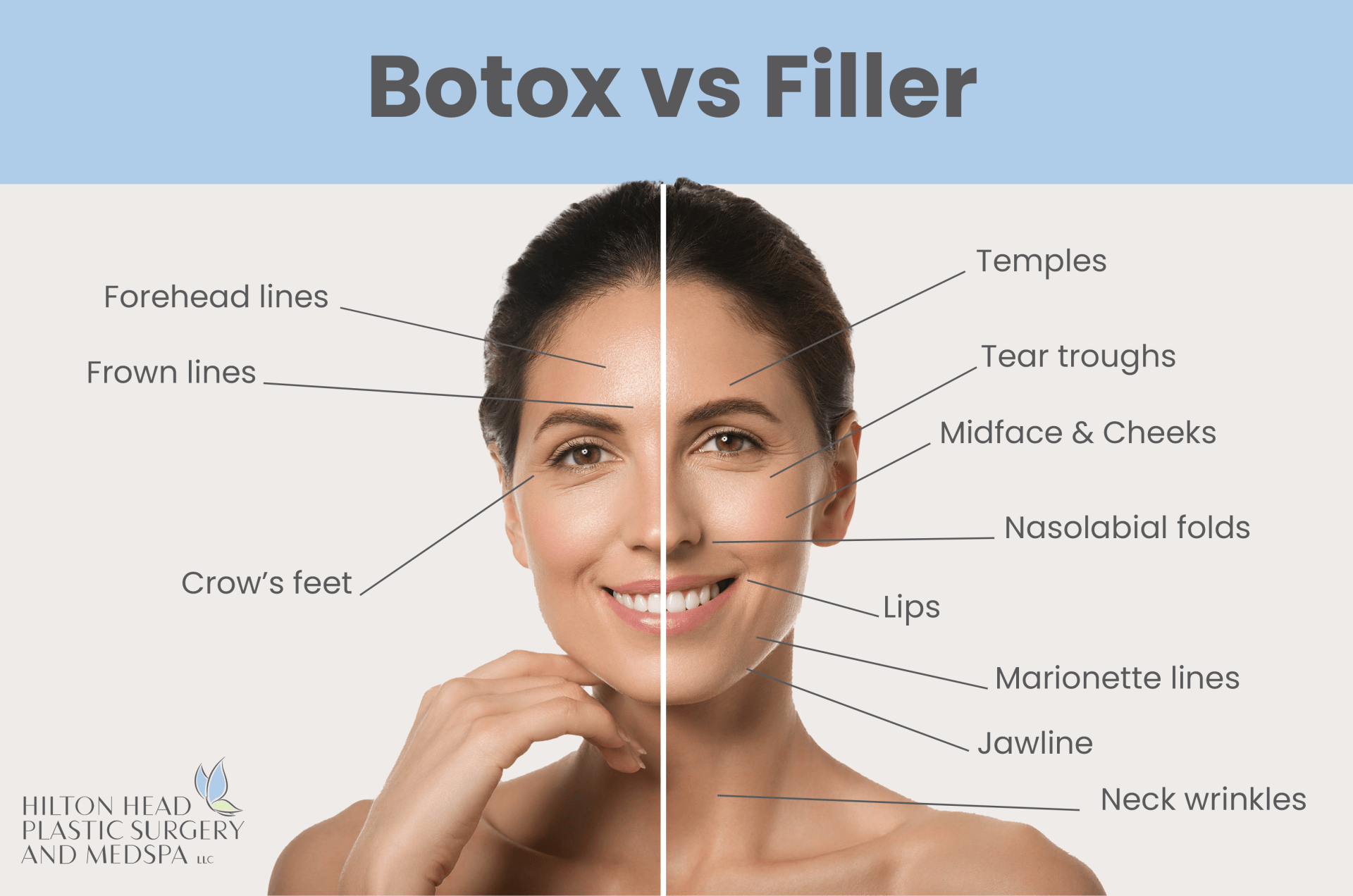 Botox treatments