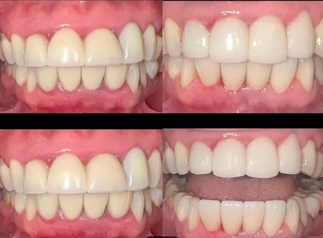 clean and white teeth