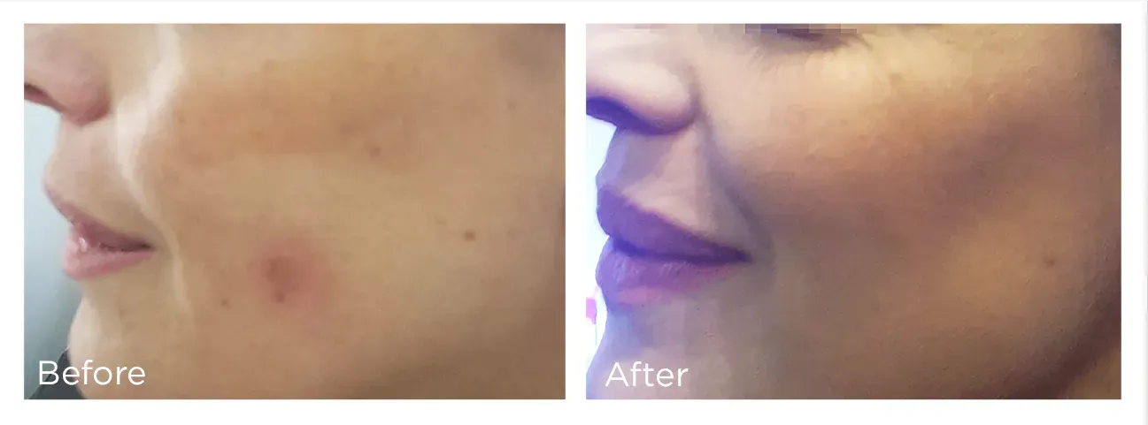 icl-skincare-therapy-freezepen-before-and-after-treatment