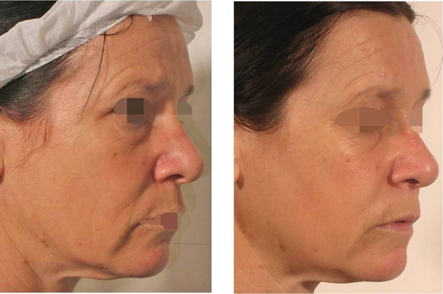 icl-skincare-therapy-before-and-after