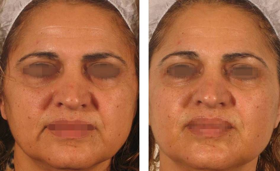 icl-skincare-therapy-before-and-after