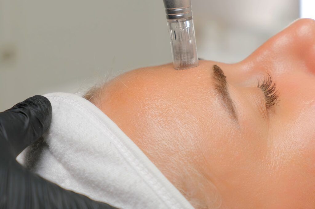 icl-skincare-therapy-micro-needling-forhead