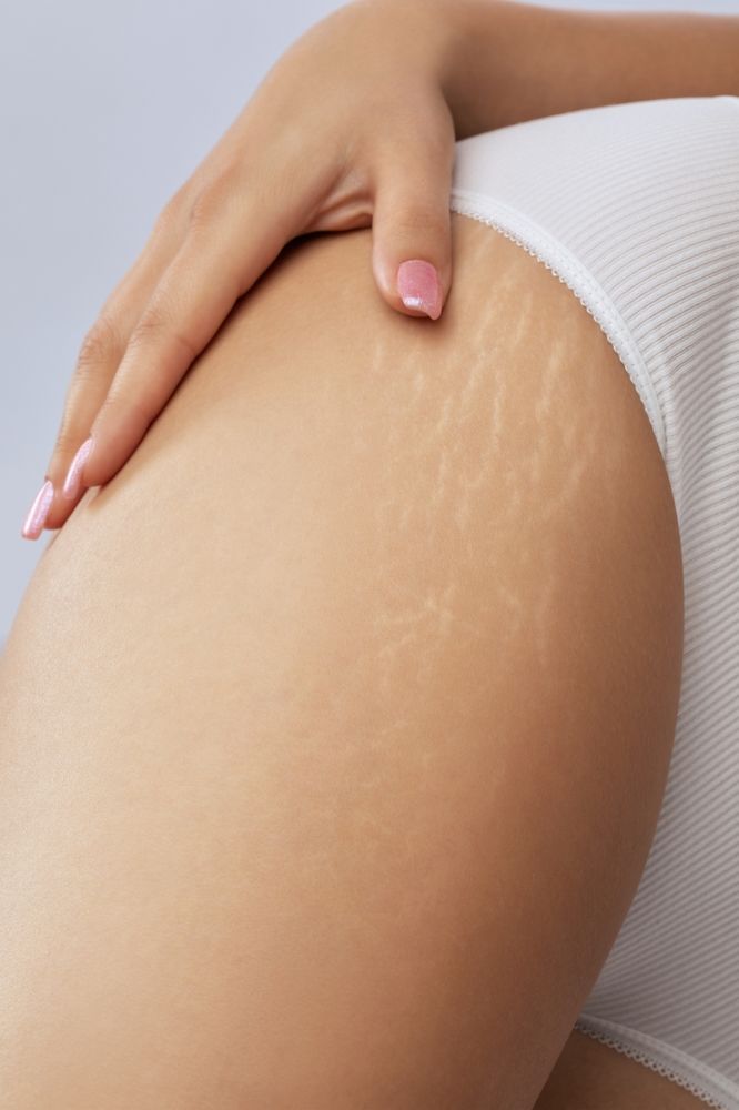Close-up of a person's thigh with visible stretch marks, hand resting on it, wearing white underwear.