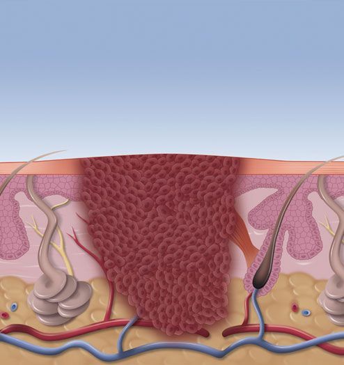 Cross-section of skin showing a deep wound filled with red tissue. Hair follicles and blood vessels are visible.