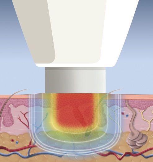 Cross-section of skin showing a device emitting energy causing tissue damage in shades of red, yellow, and blue.