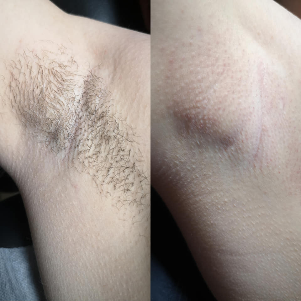 Kūno / veido depiliacijos paslaugos