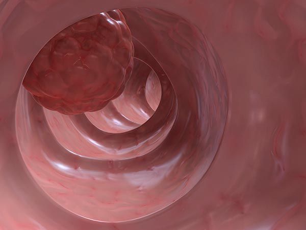 Biopsia de ganglio centinela: Una técnica diagnóstica en el cáncer