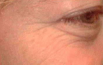 cosmetic injections to get rid of crows feet before picture